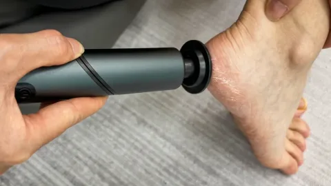 Qinux CalluVex – Foot Calluses&Corns Remover